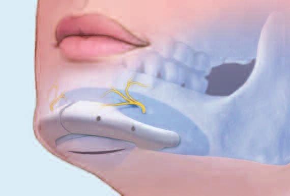 La fijación con tornillos inmoviliza el implante colocado y elimina cualquier posible separación entre la cara interna del implante y la superficie del esqueleto facial.