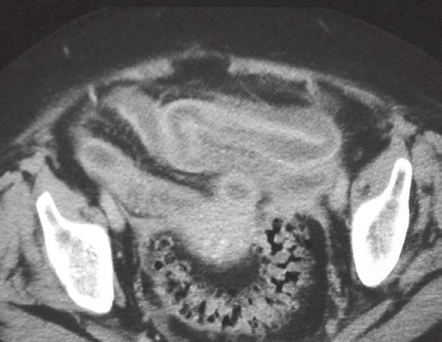 CT of small-bowel obstruction: value en establishing the diagnosis and determining the degree and cause. AJR Am J Roentgenol 1994; 162: 37-41. 4. Fukuya T, Hawes D, Lu C, et al.