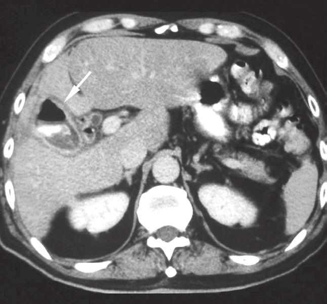 Helical CT in the diagnosis of small bowel obstruction. Radiographics 2001; 21: 341-355. 6. Herlinger H, Rubesin SE. Obstruction. In: Gore RM, Levine MS, Laufer I, eds.
