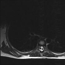 RMN: --18-8-2009: Alteración de intensidad de señal en toda la médula, mayor en transición cérvico-dorsal (siendo la más llamativa una lesión localizada a nivel T10, que muestra leve realce con
