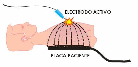 ticas -Electrocirug Electrocirugía Notar que la densidad de corriente en el electrodo activo es mucho mayor a la del electrodo neutro ya que toda la corriente que entra por
