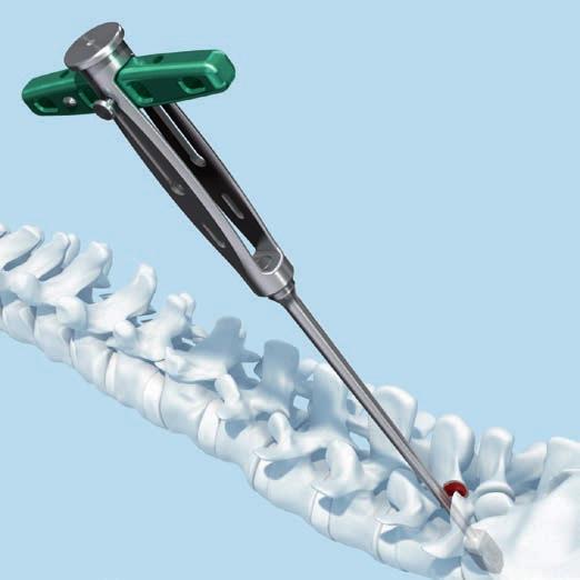 Implantación Introduzca el implante de prueba con la marca grabada que representa la altura de la prueba orientada en sentido