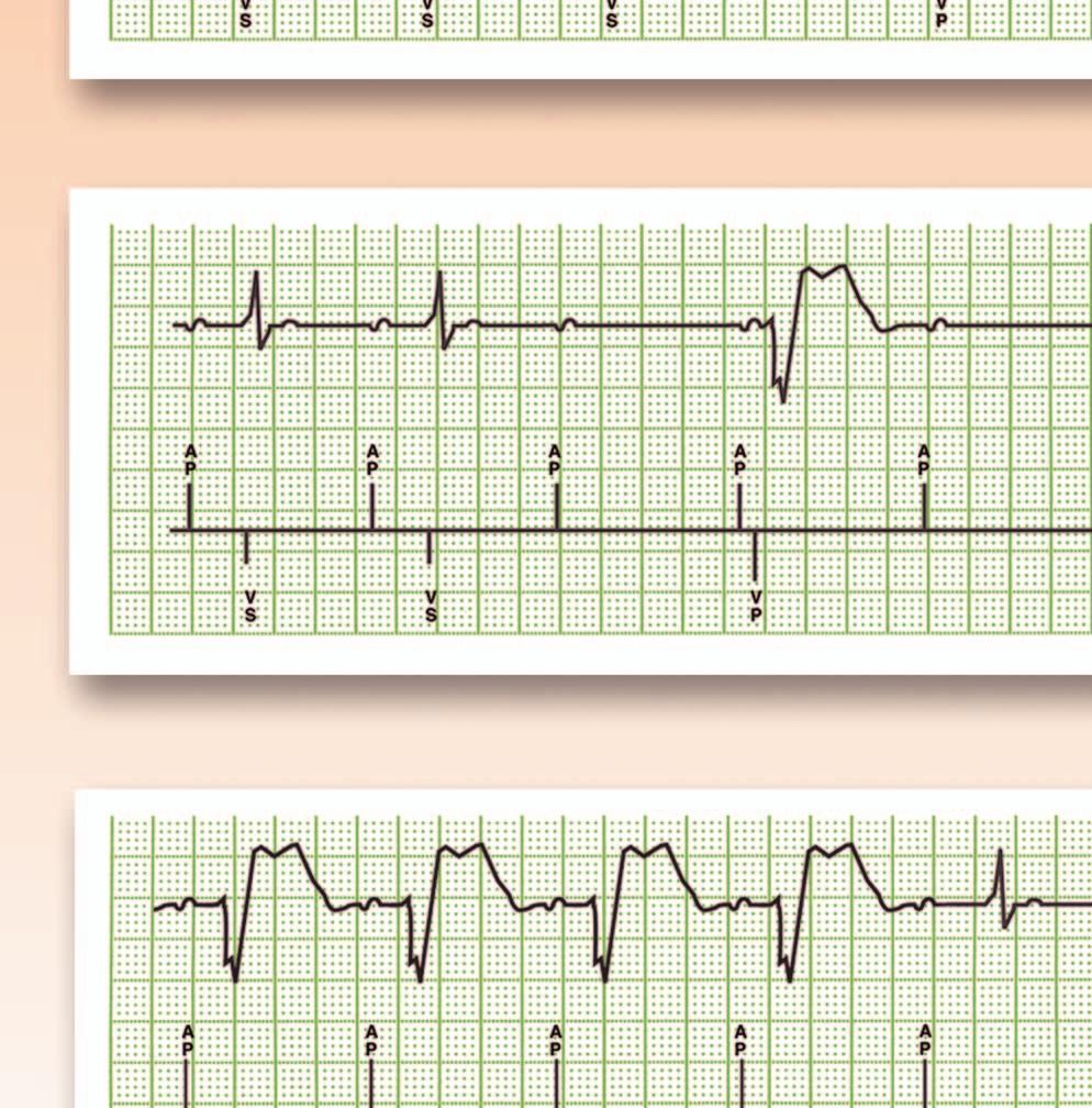 Respaldo ventricular si la pérdida de conducción AV es persistente * DDD(R) a AAI(R) Cambio de