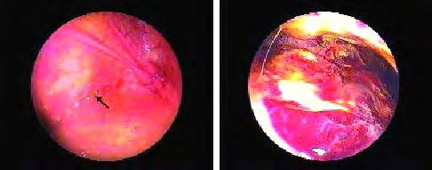 Figura 2.- Aspecto endoscópico de lesiones en fondo vaginal poscubrición de dos yeguas: lesión superficial (izquierda) y profunda (derecha).