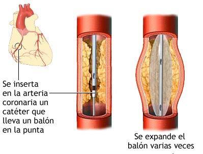 el paciente puede notar dolor en el pecho (angina) en el momento de la dilatación.