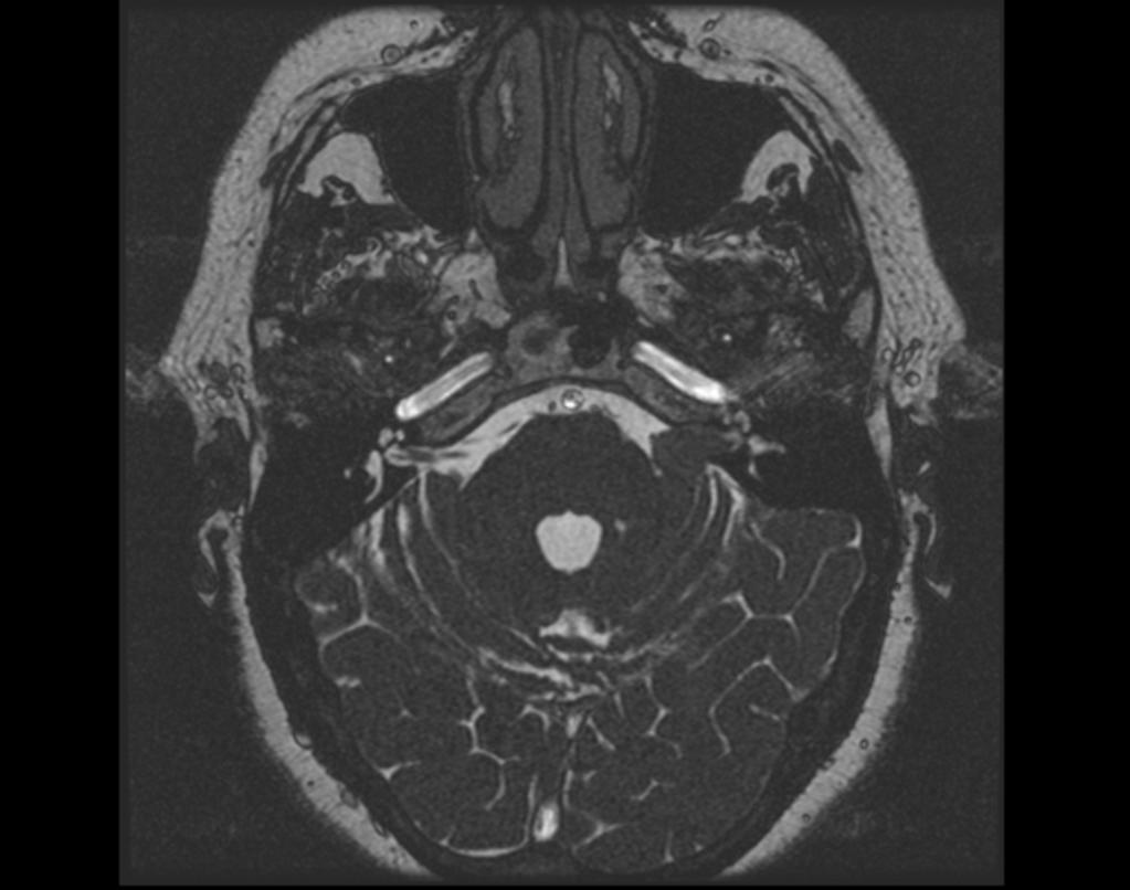 Fig. 12: Caso 6: Neurinoma del acústico izquierdo operado. Pequeño resto tumoral de 5x3mm claramente visible en ambas secuencias. Fig.
