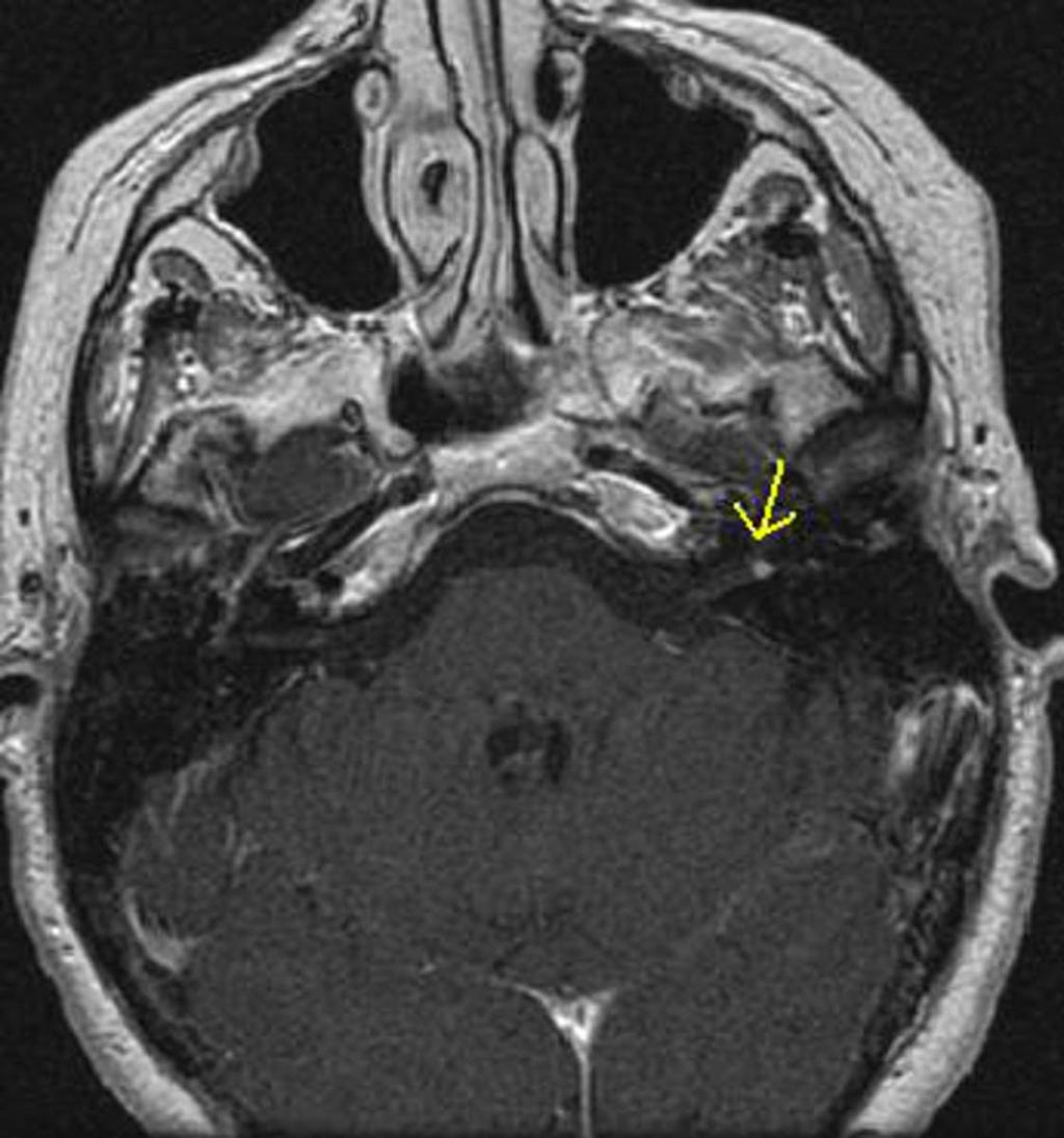 Fig. 1: Caso 1: Mujer de 57 años. Neurinoma del acústico intracanalicular izquierdo de 3.