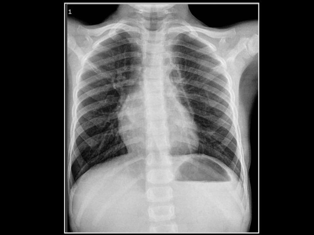 Fig. 11: Paciente de 4 años de edad con enfisema lobar congénito del LSI. Se realiza lobectomía del LSI por toracoscopia.