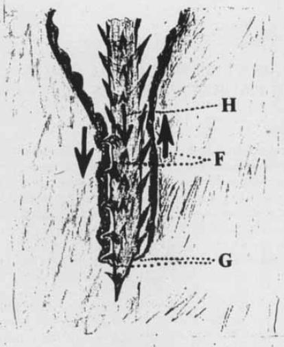 Introducción 1. El invasor (Hair (H)), consistente en restos de pelos sueltos que se acumulan en el surco interglúteo.