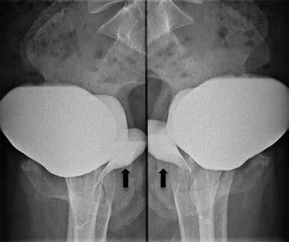 Ramírez-Arango J et al. Cistouretrografía miccional Figura 9. Radiografía lateral de pelvis donde se evidencia fístula vesicovaginal (flechas). Figura 10.