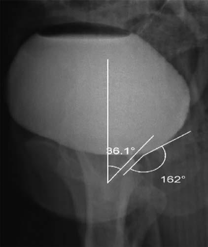 Anales de Radiología México 2017 enero;16(1) Figura 7. Alteración del ángulo de inclinación uretral anterior y uretrovesical posterior (incontinencia por hipermotilidad tipo II).