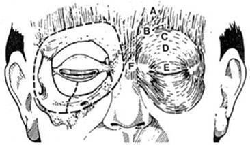 Blefaroespasmo Compromete músculos orbiculares oculares (C,D,E) y