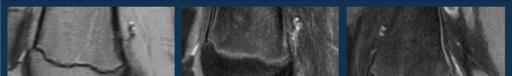 Rotura parcial aguda focal distal Las lesiones