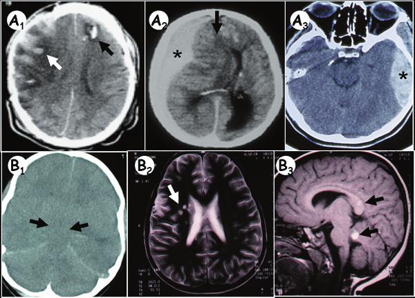 Prieto y col 2009; 20: 225-244 Figura 1. Tipos de lesiones cerebrales post-traumáticas agudas observadas en los estudios de neuroimagen.