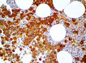 neoplasias Cadenas ligeras kappa y lambda Inmunoglobulina