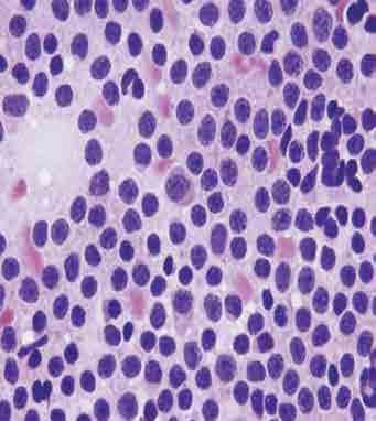 Macroglobulinemia de Waldenström Linfoma linfoplasmacítico que involucra la medula ósea Presencia de IgM sérica (a cualquier concentración) Mezcla variable de linfocitos,