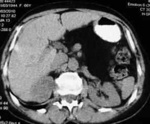 Pancreatitis crónica(pc), fibrosis