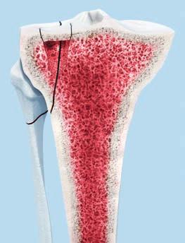 El proceso de reducción de la fractura ocasiona a menudo defectos de esponjosa que deben rellenarse con material óseo para poder conseguir la fijación anatómica.