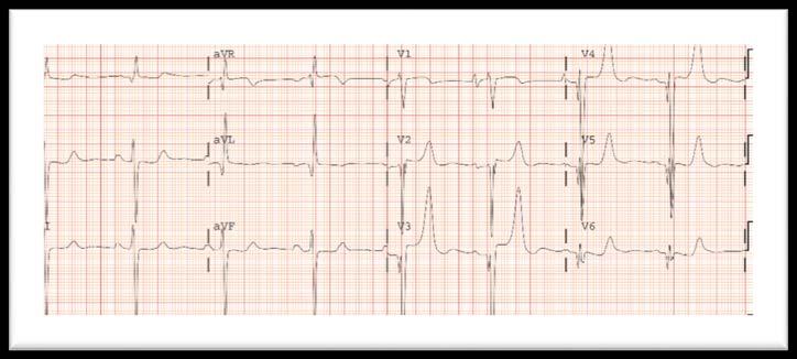 Hiperpotasemia. Bloqueo AV congénito. Sd de QT corto. Figura: Presencia de onda T picuda en V3-V6 (y elevación de ST en V2-V5) por enfermedad hipertrófica del ventrículo izquierdo. #ECG_Telegraph 41.
