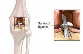 LESIONES LIGAMENTOSAS. ESGUINCE O DISTENSIÓN Elongación de los ligamentos que sujetan una articulación, producido por un movimiento forzado.
