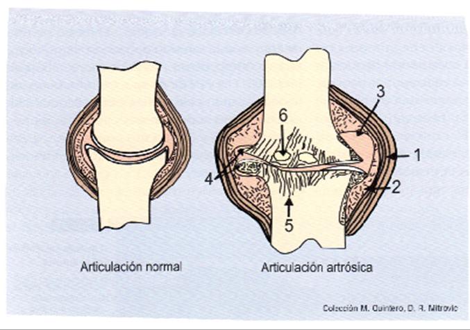 Osteoartritis Lesión músculo esquelética mas común en el mundo MAS DE 21.000.