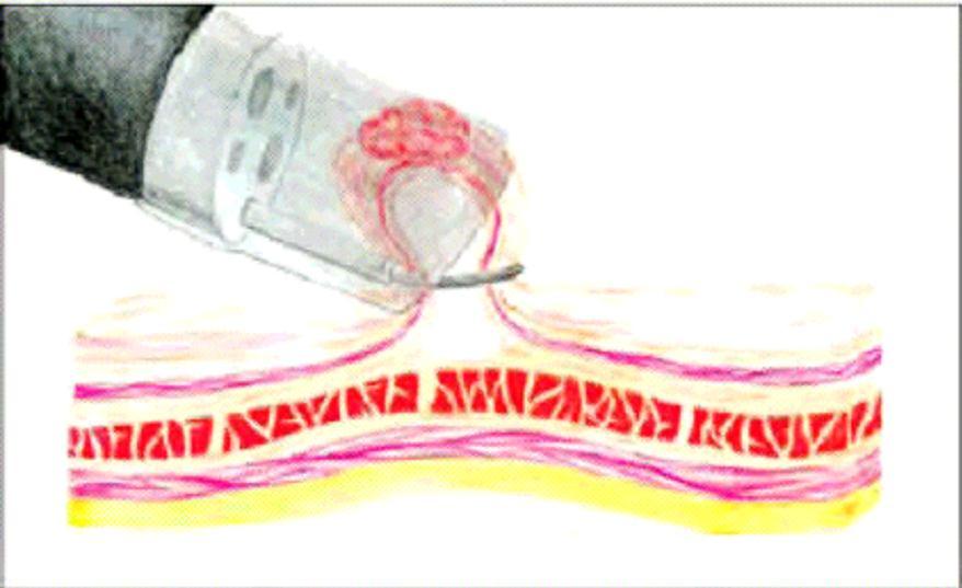 3 REM asistida con capuchón Antes de iniciar la REM, se coloca un capuchón plástico transparente en el extremo del endoscopio.