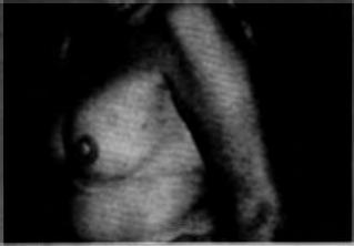 A. da Matta Fig. 5A. Preoperatorio: mastectomia radical modificada. Fig. 58. Reconstrucción con expansor del tipo Becker. 2 tiempos.