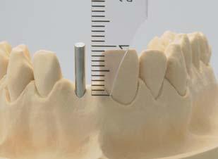 7 8 9 La férula de resina se transfiere al  La posición del implante determinada en