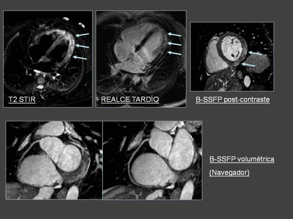 Fig. 8: Paciente con dolor torácico agudo y alteraciones en el ECG. Se estudió con secuencias STIR que mostró edema ventricular con localización medio y subepicárdica (miopericarditis).