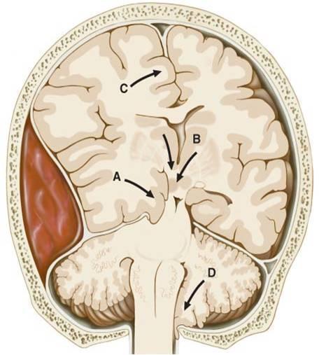 Compresión de parénquima cerebral y vasos sanguíneos con