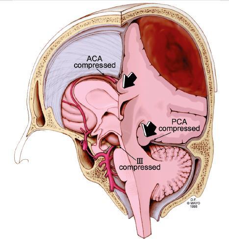 Compresión ACA en hernia subfalcina y PCA en hernia