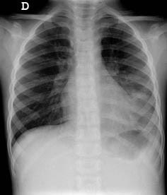 cavitaciones o masas), o si son extra-pulmonares (provocadas por líquido o aire ectópico).