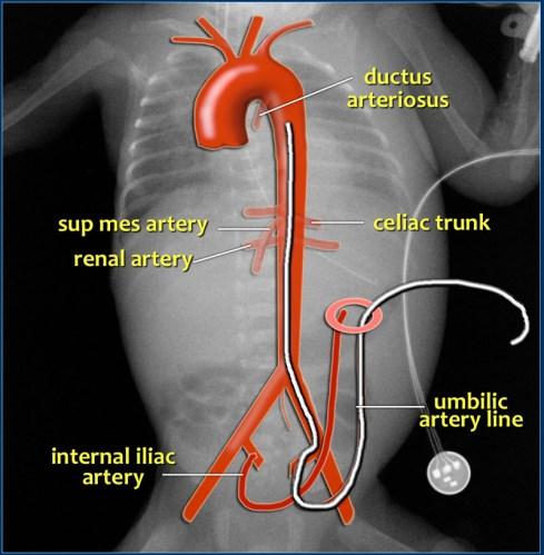 CIRCULACIÓN ARTERIAL Durante la vida fetal, las arterias umbilicales descienden hasta su unión con las arterias ilíacas.
