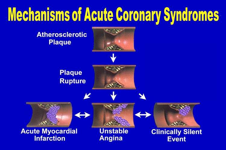 Mecanismo de Oclusion en los Sindromes Ateroma Coronarios Agudos Ruptura de placa