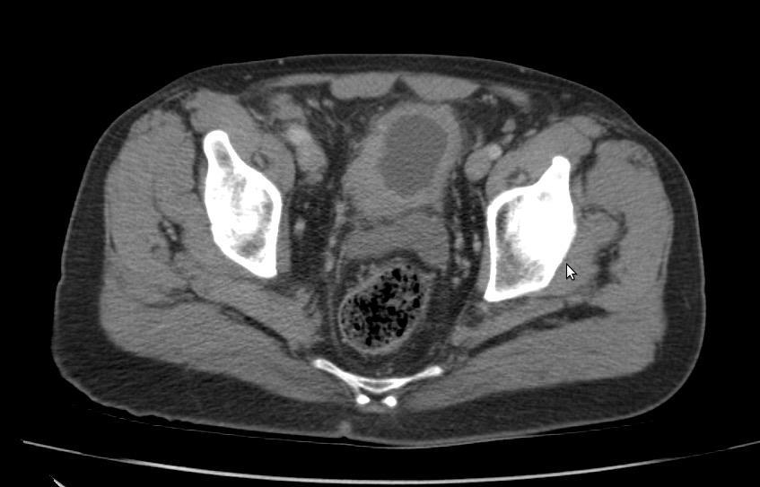 Diagnóstico Imagen 1. TAC abdominopélvico (corte axial).