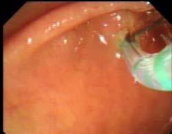 El endoscopista canuló retrógradamente la VBP con un esfinterótomo directamente en la mayoría de los casos, introducido a través del canal de trabajo del duodenoscopio.