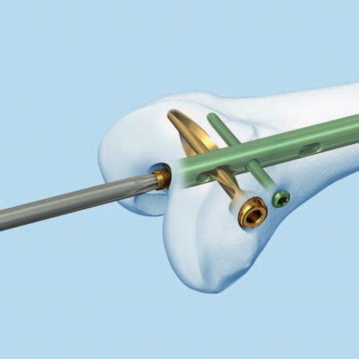 Extracción de los implantes Para el clavo femoral retrógrado /anterógrado Expert con bloqueo con hoja espiral: 1 Extracción del tornillo de cierre Instrumento 03.010.