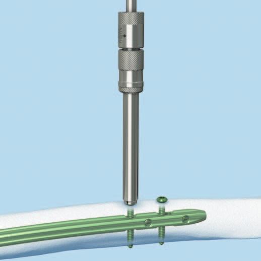 Extracción de los implantes 3 Extracción de los tornillos de bloqueo proximal Instrumentos 03.010.