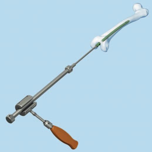 Extracción de los implantes 5 Extracción del clavo Instrumentos 03.010.056 Martillo combinado 700 g, acoplable, para ref. 357.