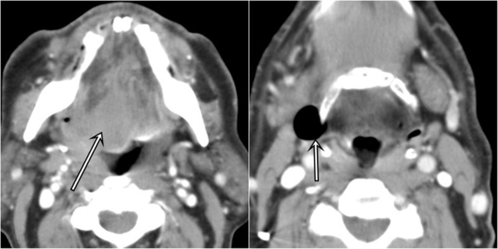 Fig. 6: Paciente en tratamiento por carcinoma epidermoide de hemilengua derecha.