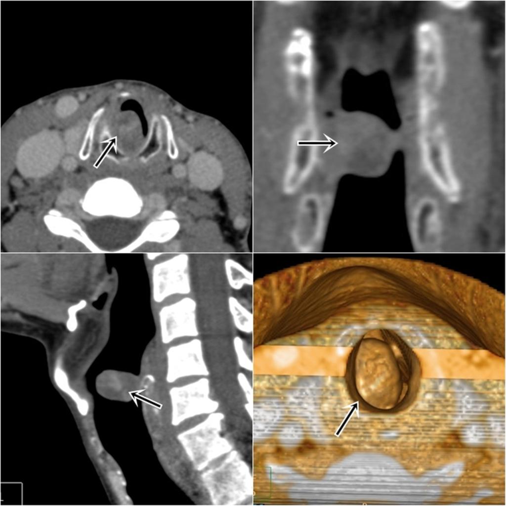 Fig. 17: Paciente con lesión polipoidea en glotis objetivada mediante laringoscopia.