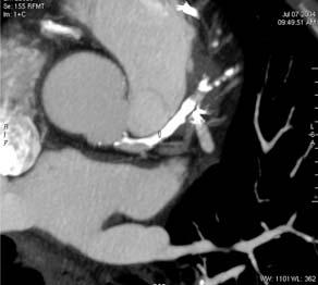 CAPÍTULO XV TEMA 46 correctamente estenosis en las arterias coronarias es superior al 90%, con un 10 % de segmentos no valorables 15.