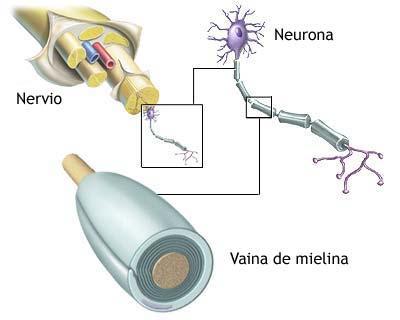 esclerosis múltiple enfermedad crónica-progresiva El desencadenamiento parece ser la descomposición de la mielina, alterando la conducción nerviosa y originando trastornos en múltiples zonas.