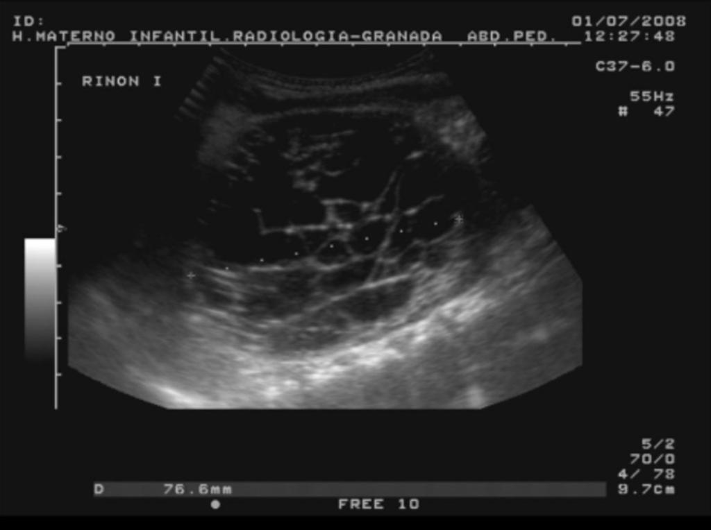 Fig. 4: Imagen superior (Nefroblastomatosis en niño de 22 meses) e inferior (Linfoma en niño de 3 años). En ambas imágenes TC tras contraste se aprecian nódulos bilaterales en parénquima renal.