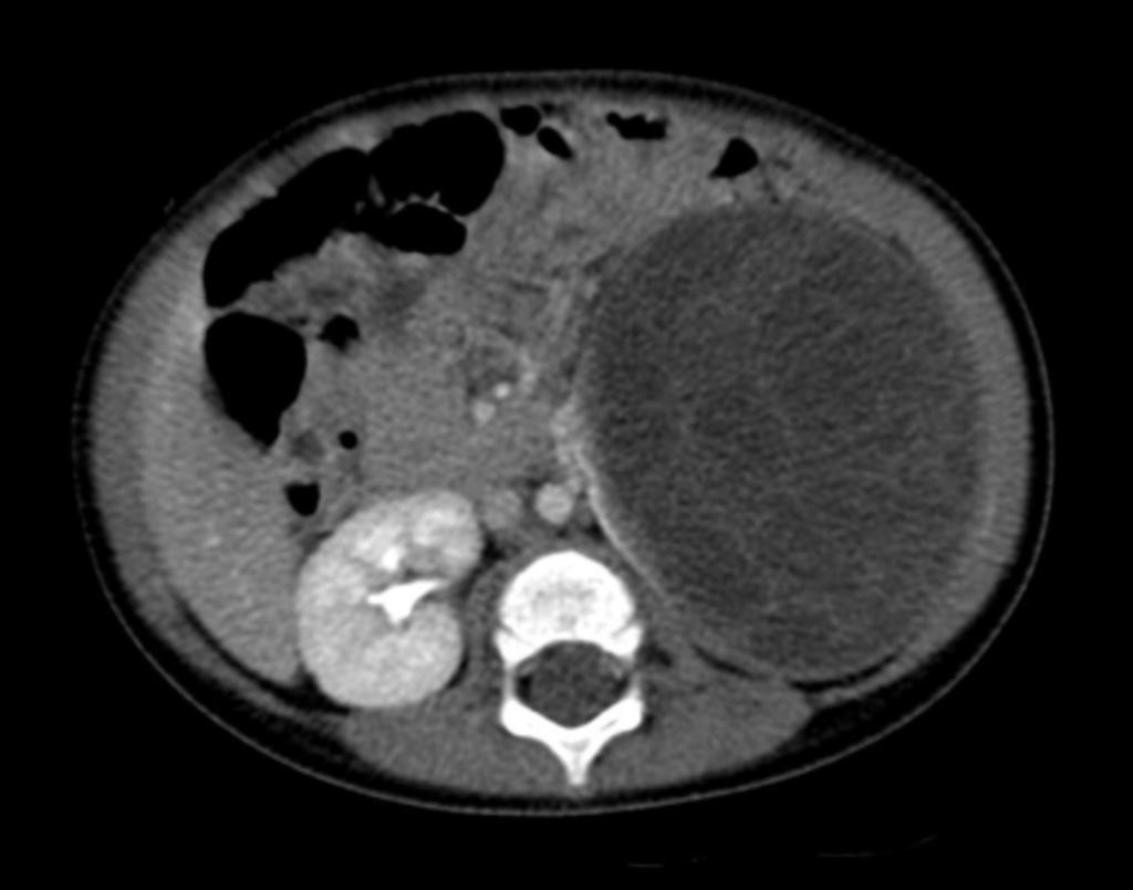Fig. 6: Imagen TC tras contraste en niño de 1 año (mismo paciente de la figura 5), con masa renal izquierda multiquística con septos captantes, que ante la