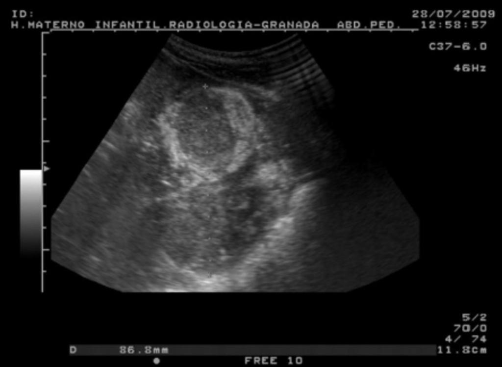 Fig. 10: Ecografía de gran masa renal izquierda en niña de 15 meses, que recuerda