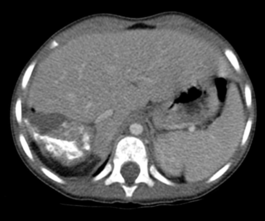 Fig. 12: Imagen TC de un neuroblastoma suprarrenal derecho en niño de 16