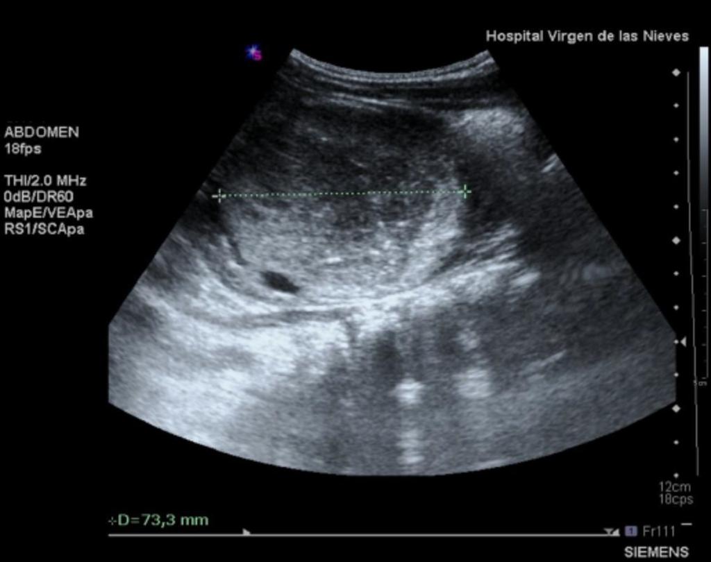 Fig. 1: Masa renal en niño de un año, heterogénea y de contornos