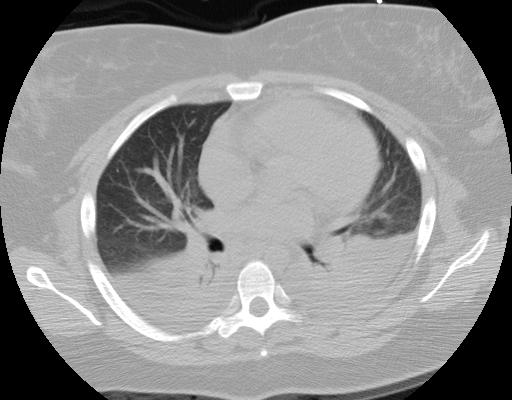 open lung approach atelectrauma recruitment and derecruitment of unstable alveoli HARMS THE LUNG if I open up the lung shunt R/D PaO 2 lung damage Muscedere JG, et al. AJRCCM 1994; 149: 1327-34.