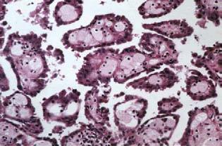 Carcinoma de células claras con predominio de células eosinofílicas. Figura 4. Carcinoma papilar renal (hematoxilina-eosina).
